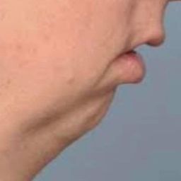 Chin